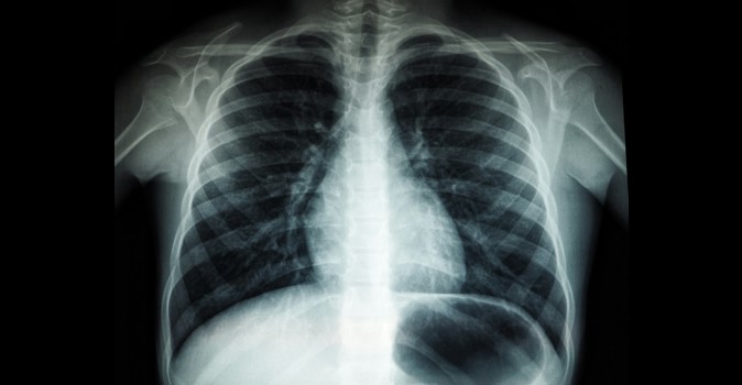 An X-ray of a chest